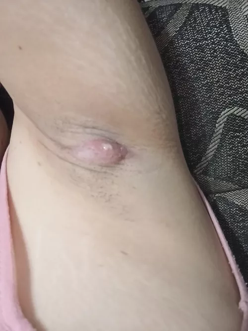 is my armpit boil finally rupturing? by prettylibrarian98