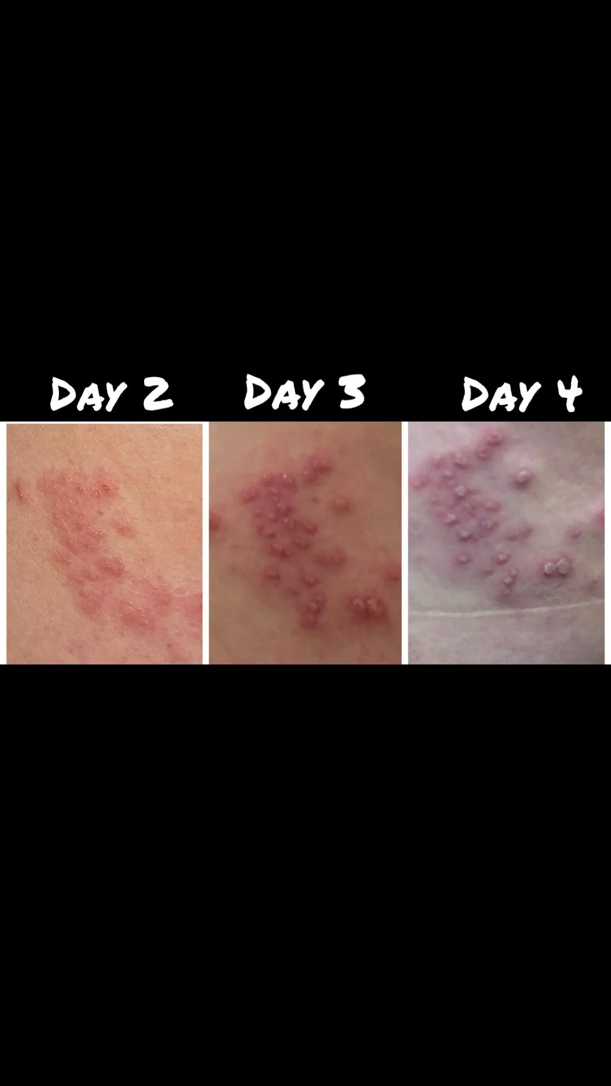 My Shingles Blisters Popped Out posted by OliveLost