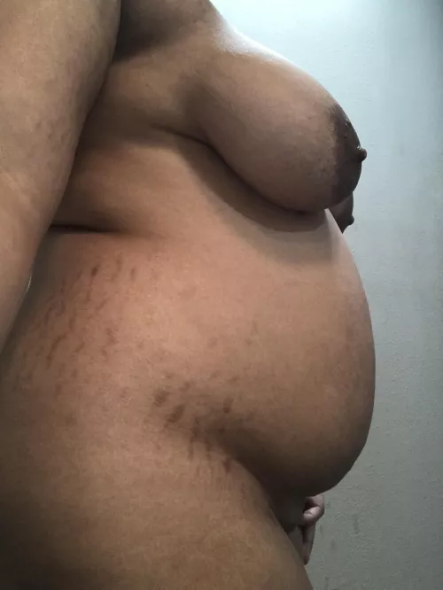 Stretch marks from growing too fast 😅 by Life_Competition4438