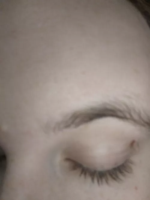 How to remove this skin tag? by bonesstackedonfloor