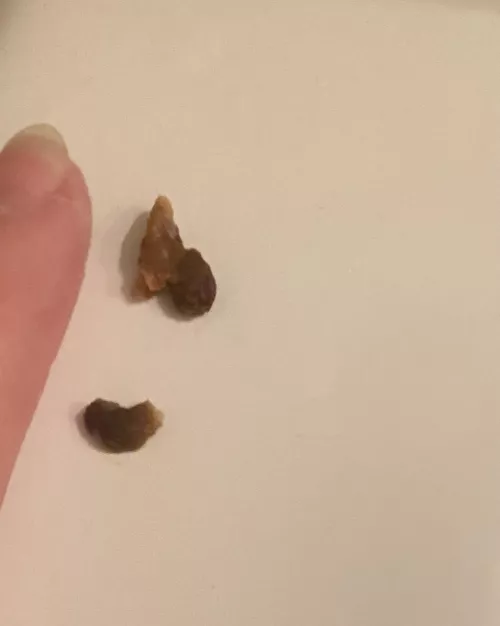 flushed these out of both ears. the world has never sounded so crisp in my life. by EverVirescent