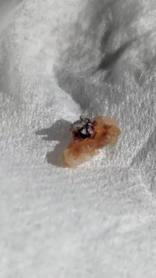 This wart that fell off my face after being frozen looks like a Nudibranch by BlazingCondor