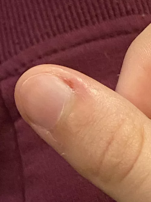 Potential paronychia by Powerful_Werewo1f