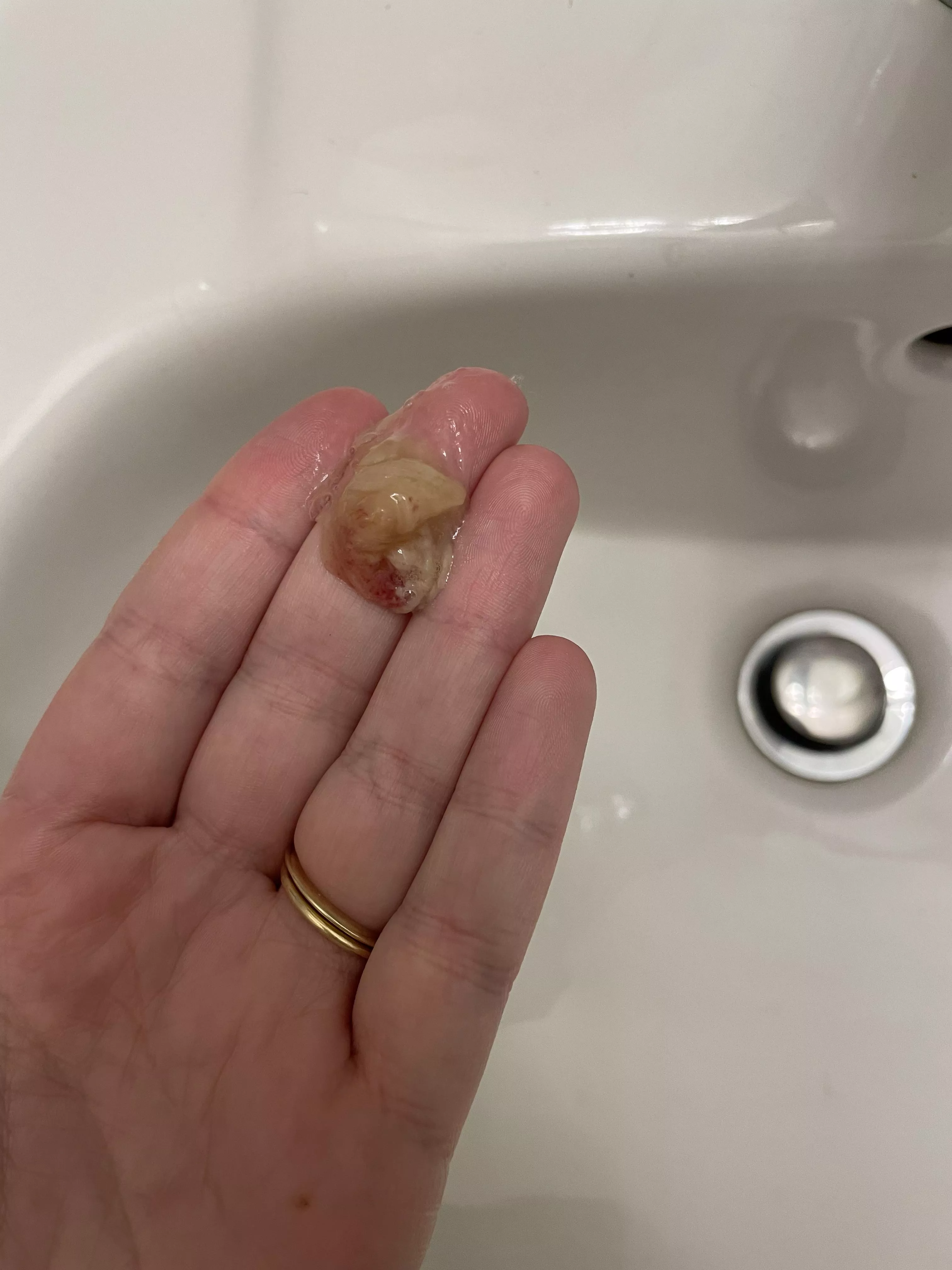 Felt this come out - dealing with strep throat posted by Fancy-Interest