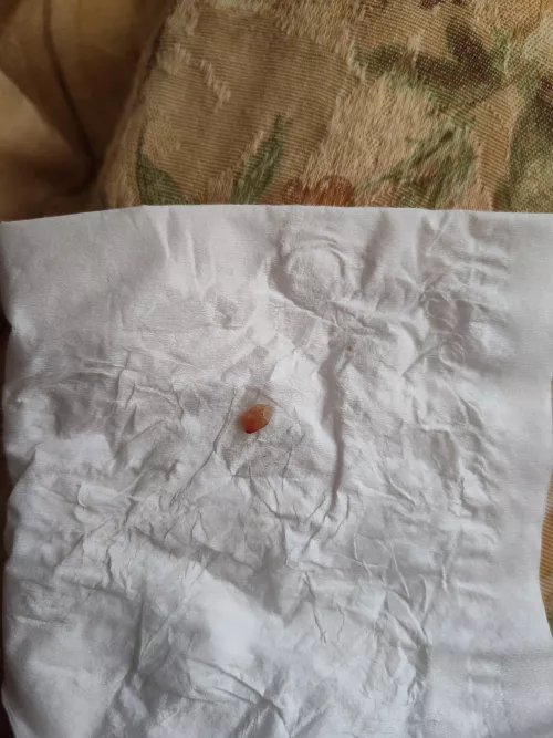 A rather odd cyst core. by esprockerchick