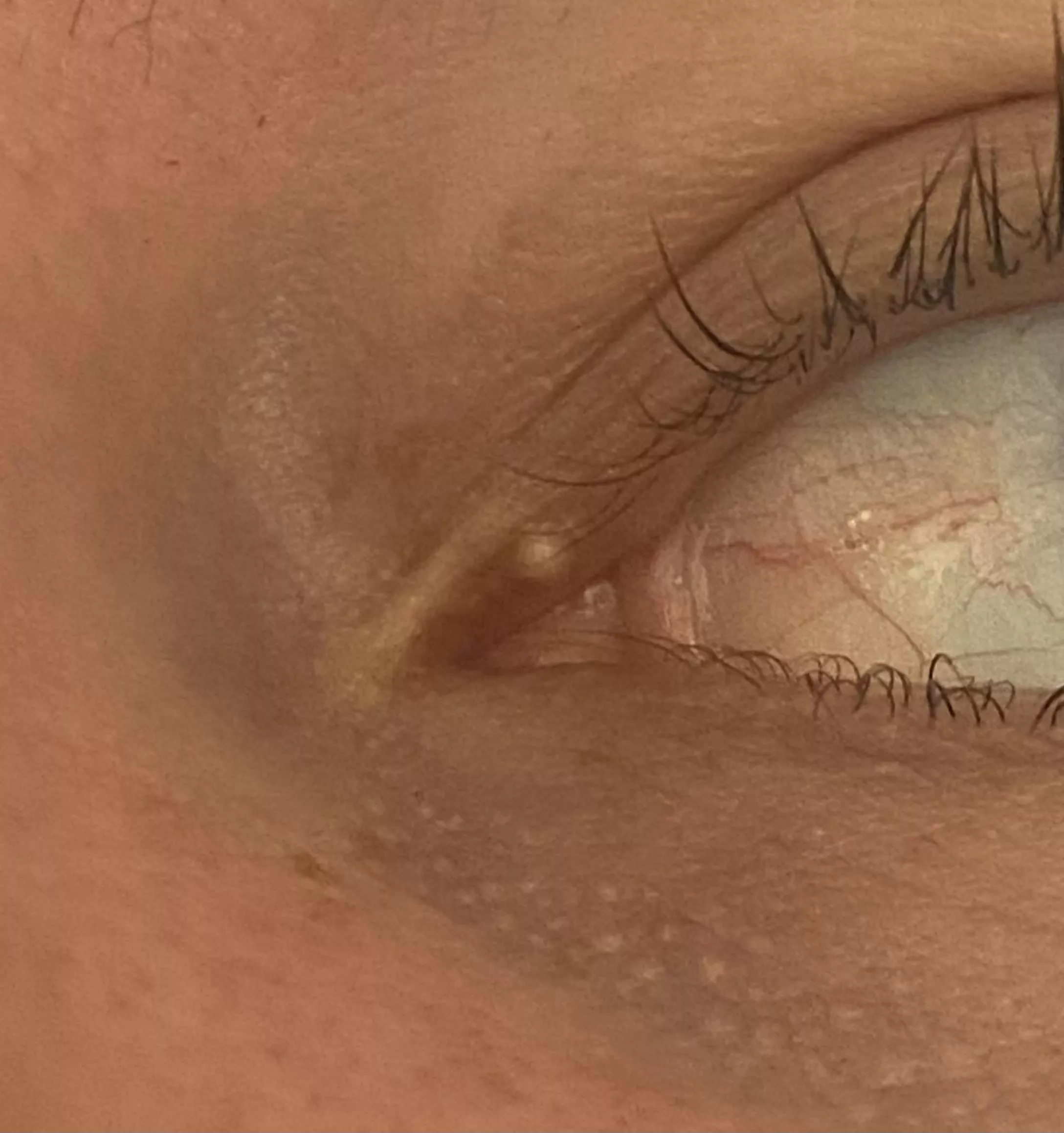 Where do I go to get this taken care of? Milia? posted by themaddhatt