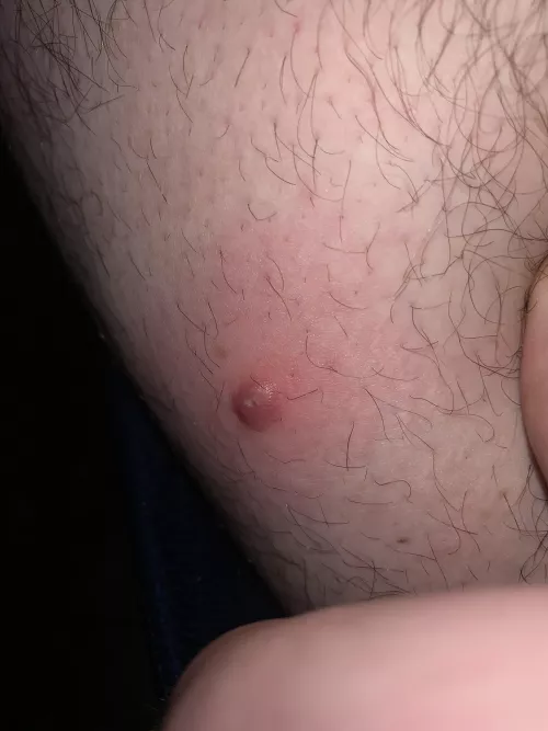 Angry red bumps on thigh by TheFuqinRSA