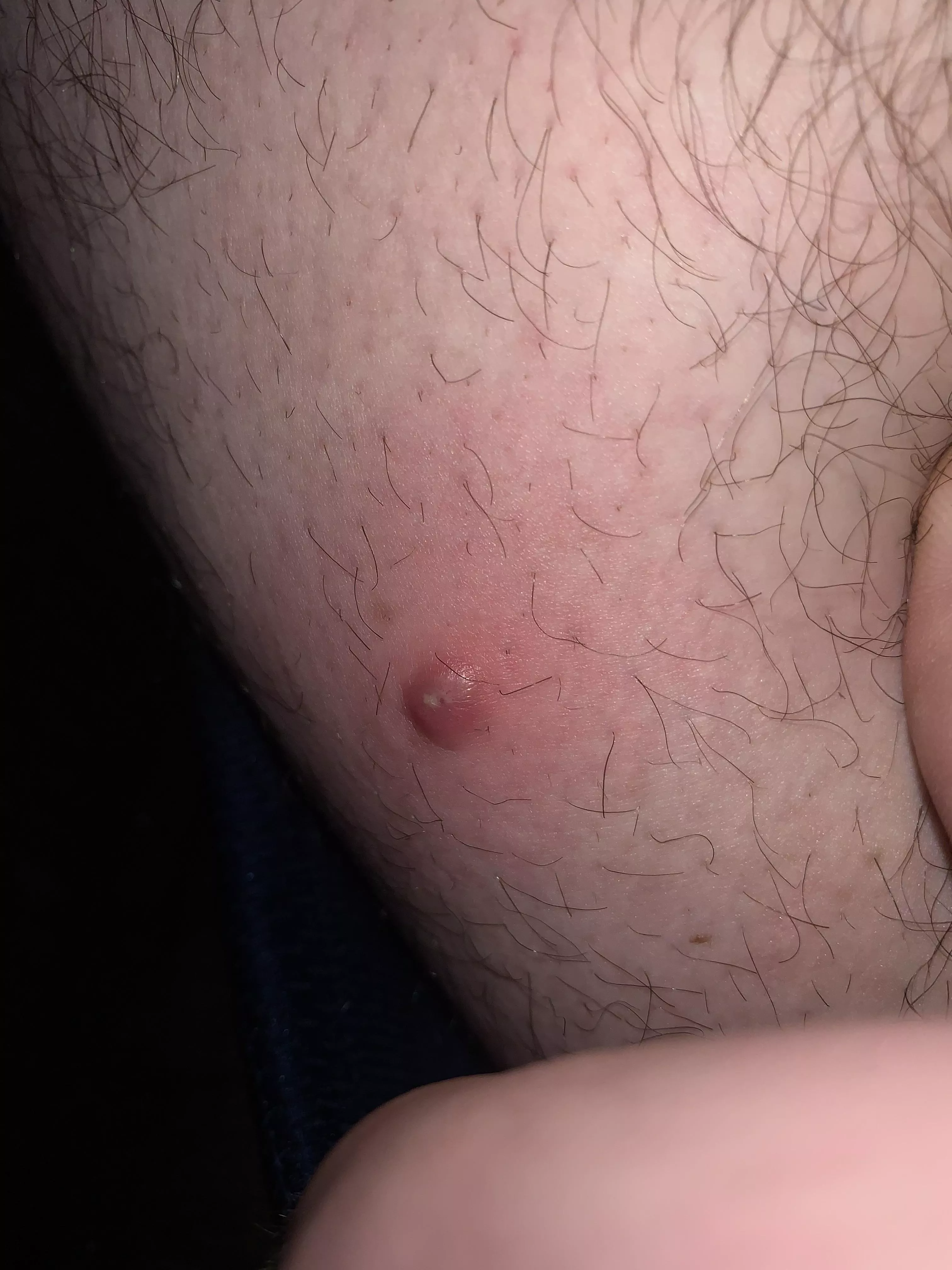 Angry red bumps on thigh posted by TheFuqinRSA