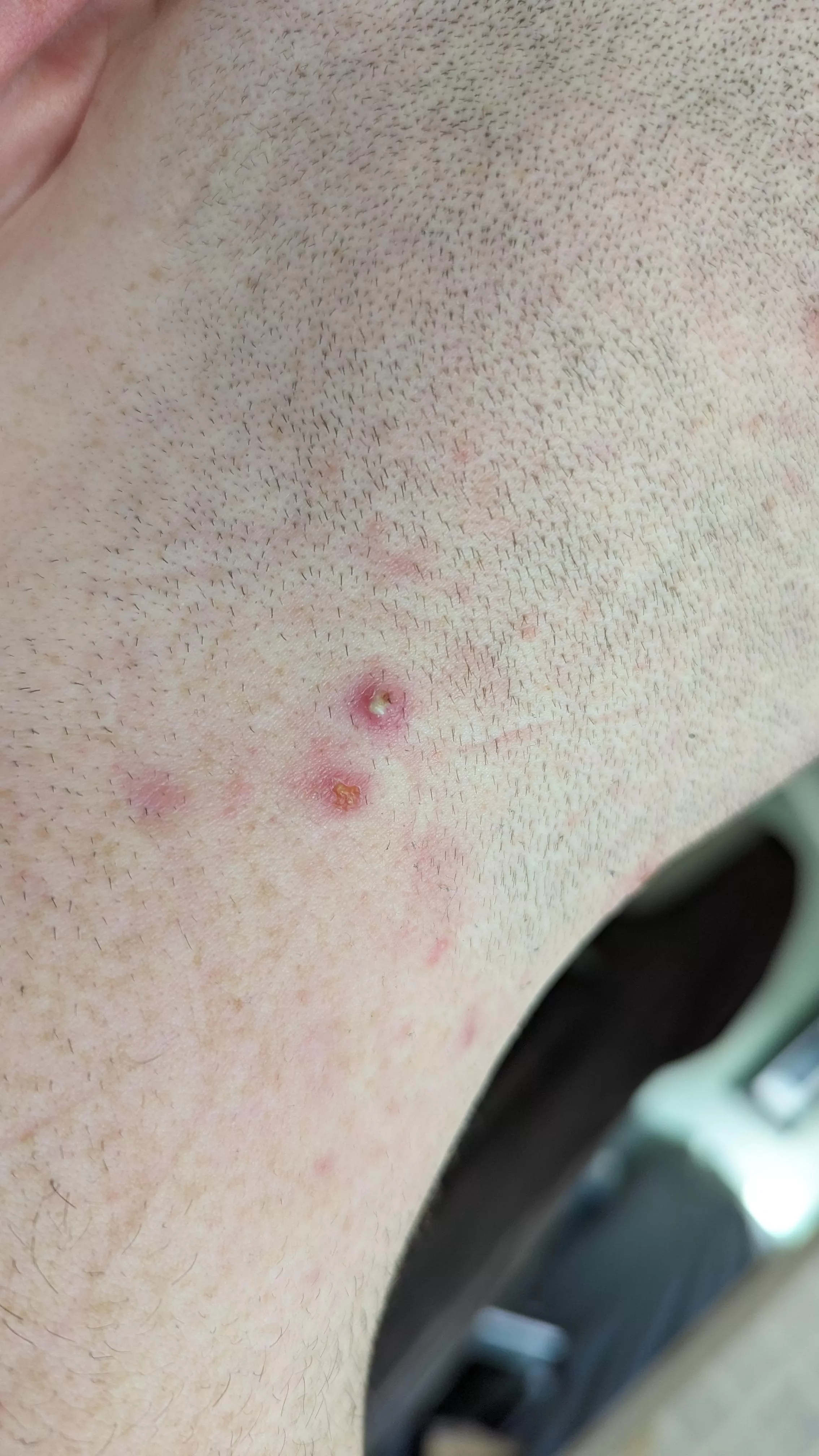 Pimple on the back of my head.  posted by SerLurkzAlot