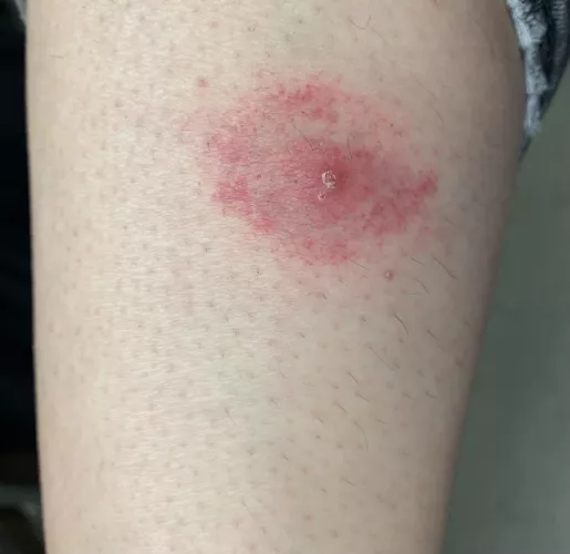 Is this a spider bite or something? I’m from Australia. It started out as just a pimple and now looks like this and i accidentally shaved over it and some puss came out. Otherwise I’ll go to a doctor if need be by aus9798
