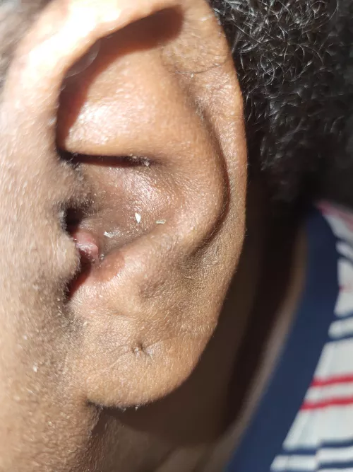 Painful Pimple in ear that won't leave part 2 by Laylaycrayz