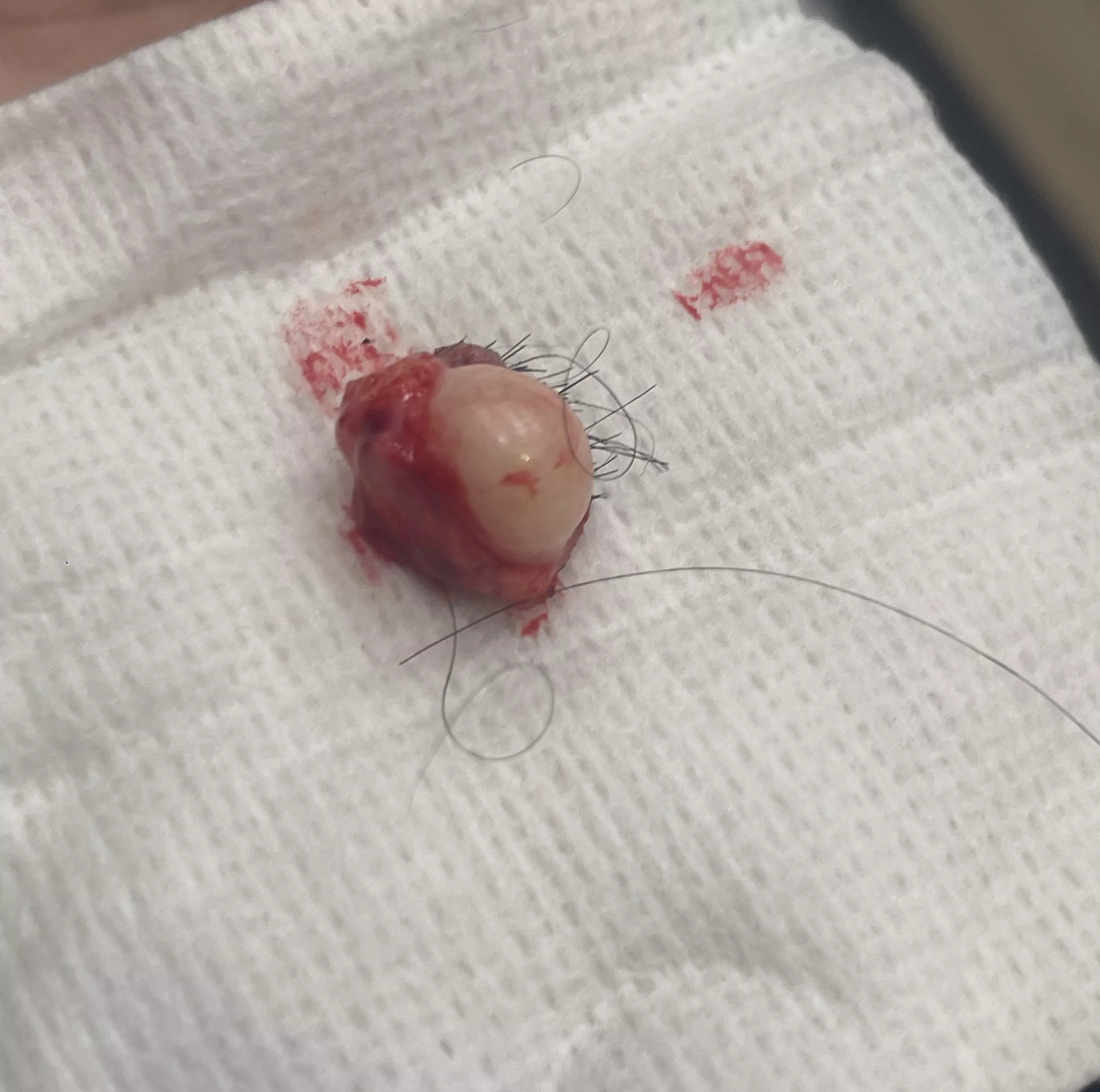 Got this sebaceous cyst removed from my scalp today. Measured about an inch across. posted by WestTexasCoyote