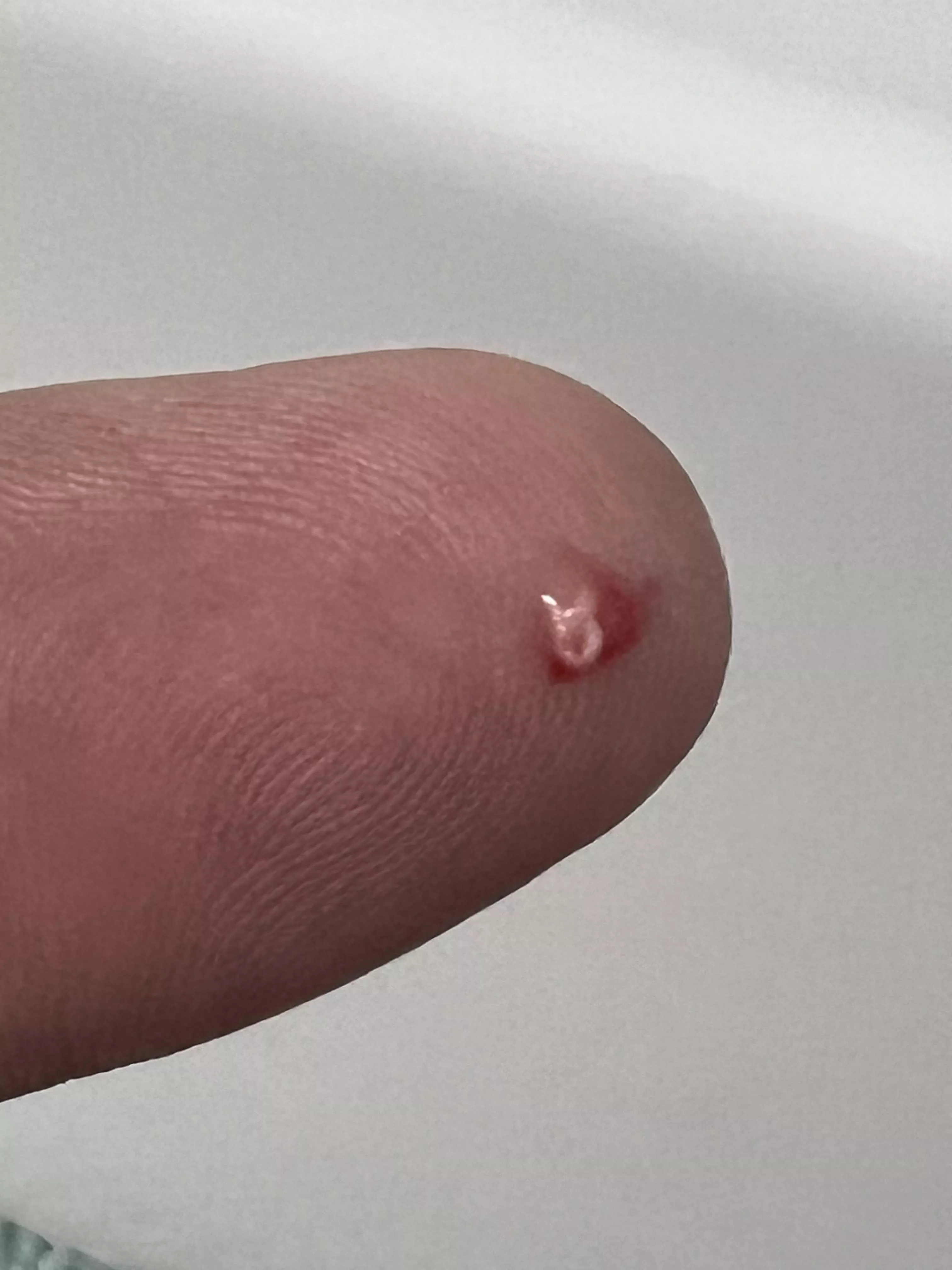 Had been brewing on my hip for a couple days. Once I popped it, all better now. posted by clezuck