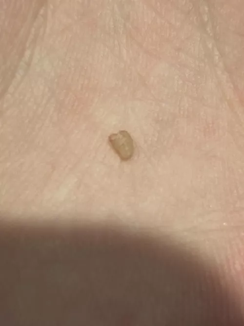 I popped and pulled this out of what started as an ingrown hair on my private part… any idea what it is? A cyst?  by Tommyl33