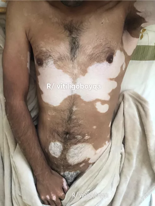 Never posted body pic before 🙄 by vitiligoboyqa