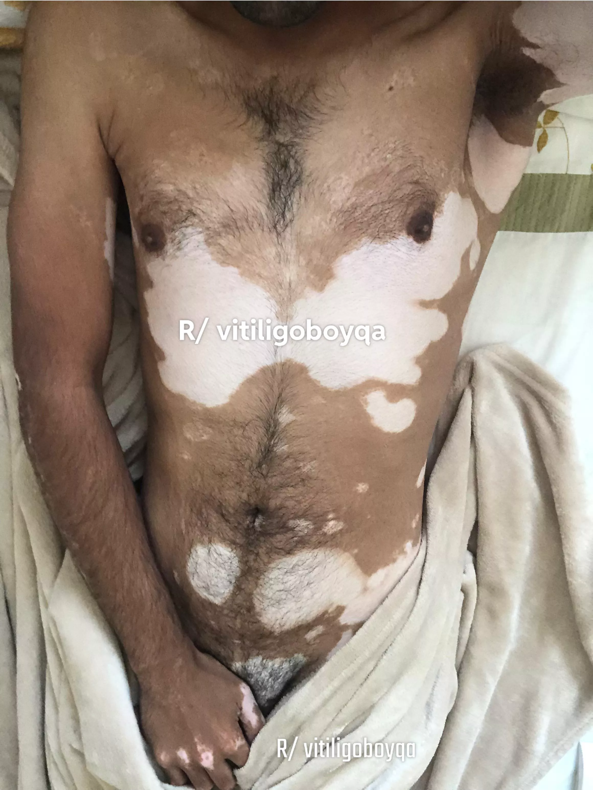 Never posted body pic before 🙄 posted by vitiligoboyqa