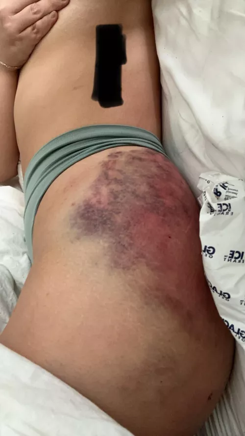 *TW* I’m a huge masochist, so don’t click if you don’t wanna see lots of bruising by _SweetPeas_