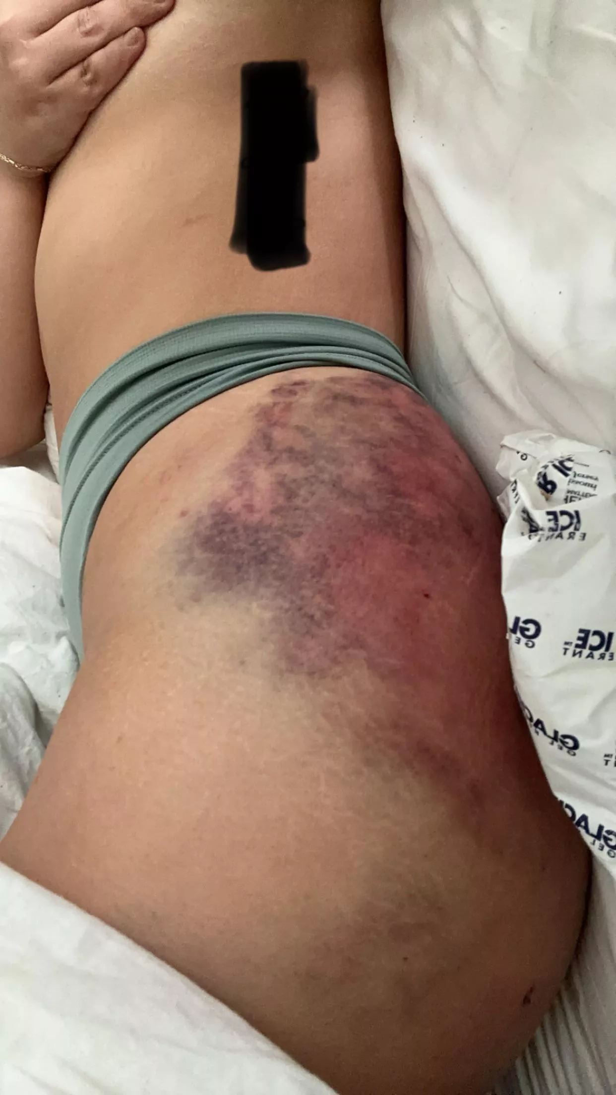 *TW* I’m a huge masochist, so don’t click if you don’t wanna see lots of bruising posted by _SweetPeas_