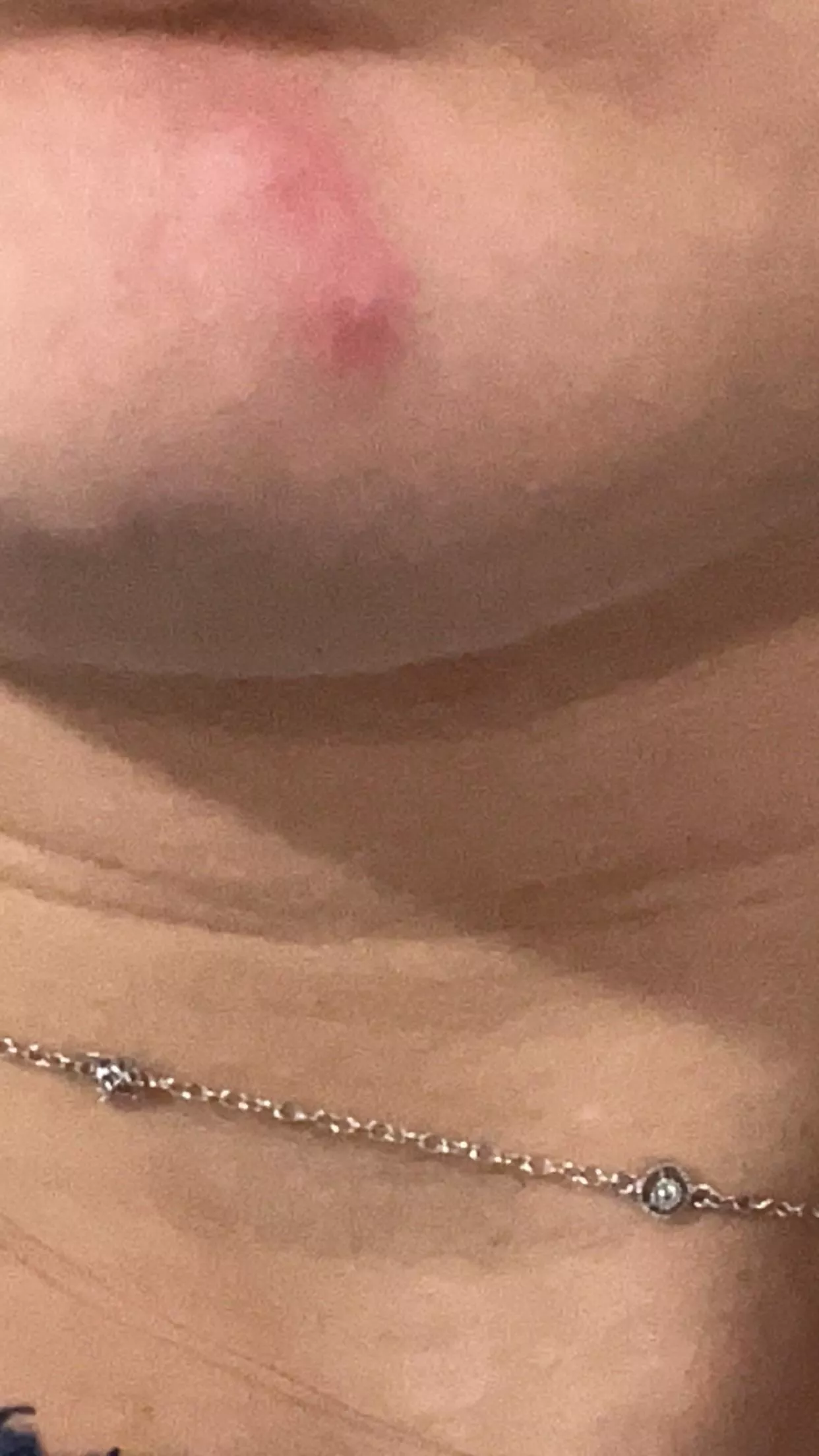 i have a double pimple???? posted by pecorinoo