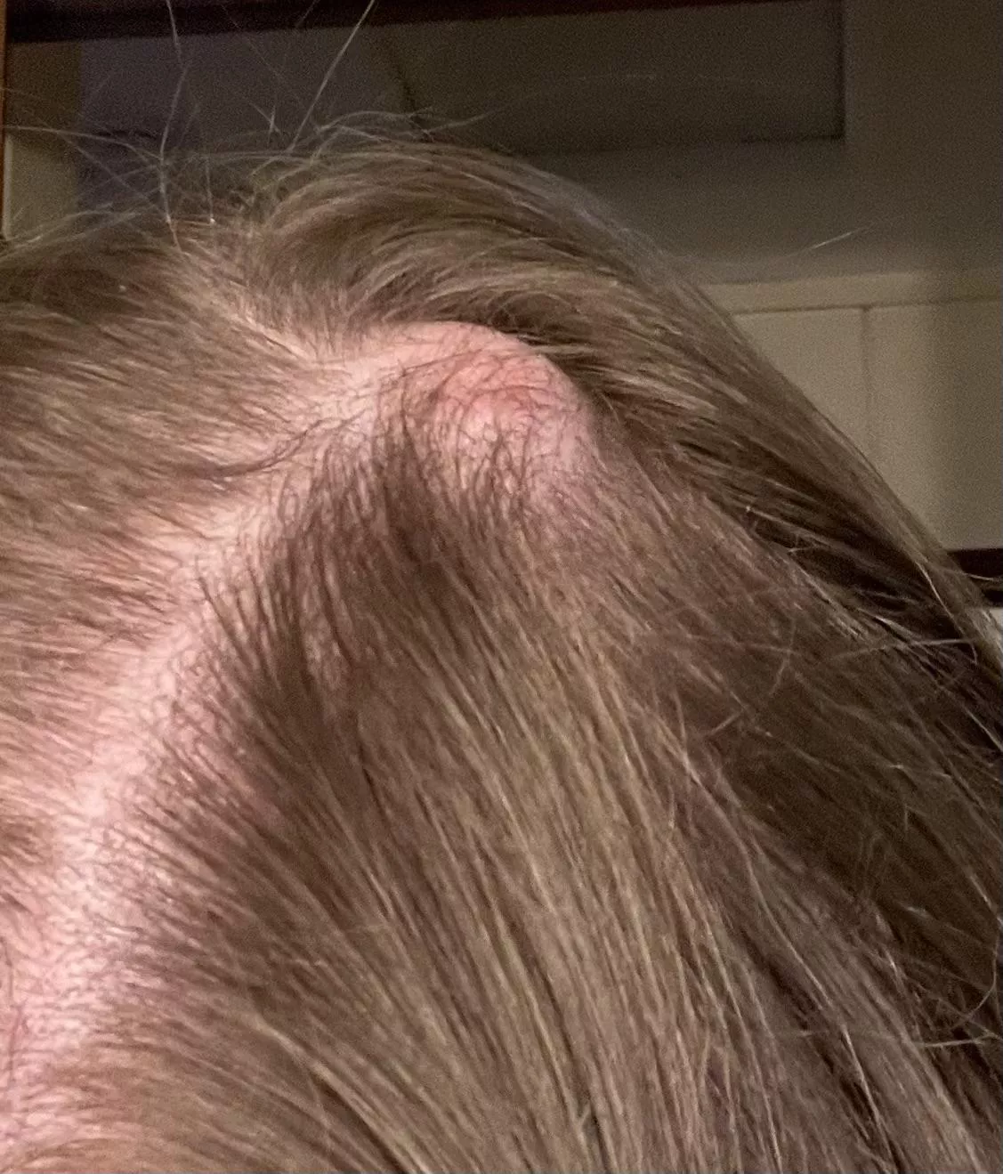 Pilar cyst to be removed  posted by Difficult-Hand-2185