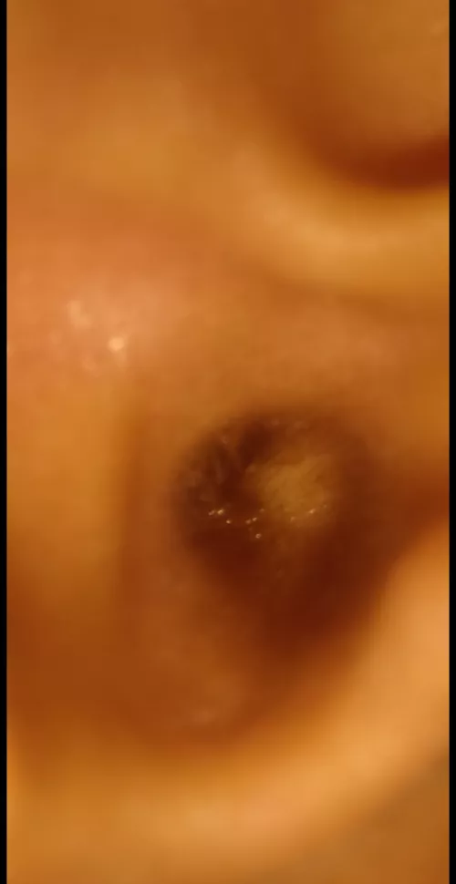 Is it a ear infection feeling pain in ear in loud noises  by ExcitementFluffy3216