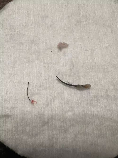 Ingrown hair/pimple ? by PTcrewser