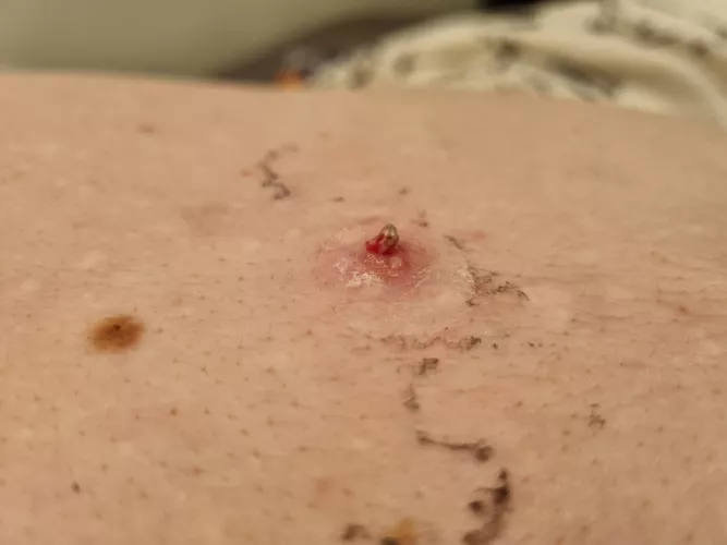 Old picture of a large, red thing brewing up. It popped on it's own under a bandaid and needed only a gentle push to get this hard nugget out of it. Instant relief. by Popping-account