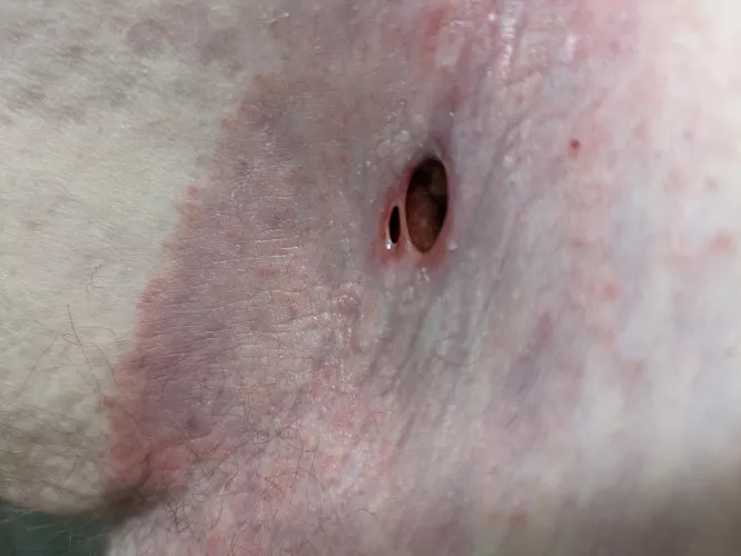 The swelling went down and a new hole formed by Ok_Manufacturer1892