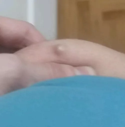 Safe to pop with a needle ? Rooted deep down on my ass... by neitherevernornever1