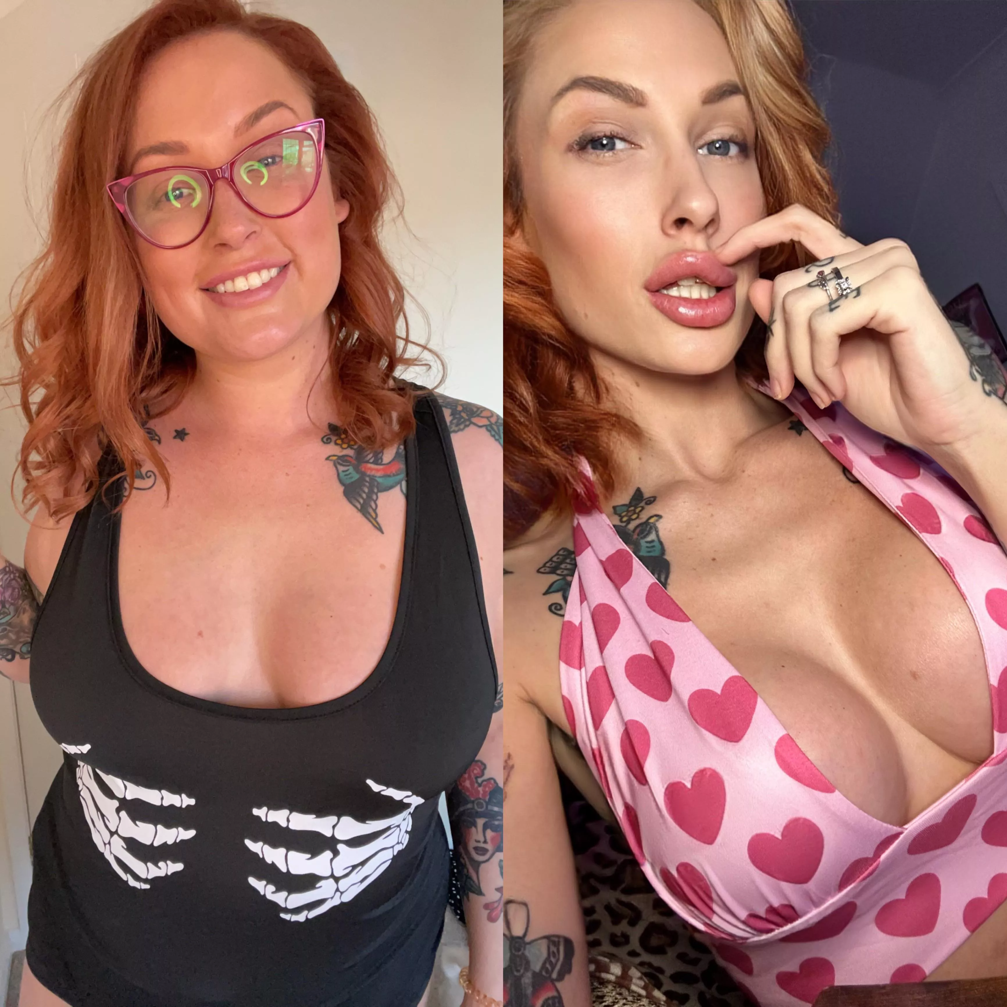 3 years between pictures, should I get more lip filler? posted by kenma91