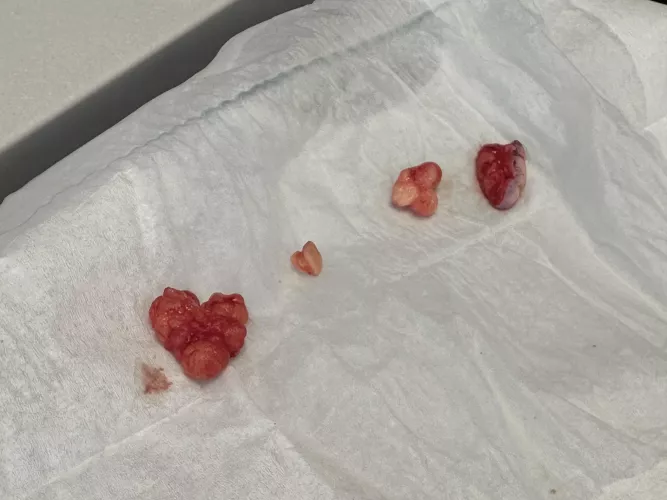 Couple lipomas and a sebaceous cyst by smokinporkbutts