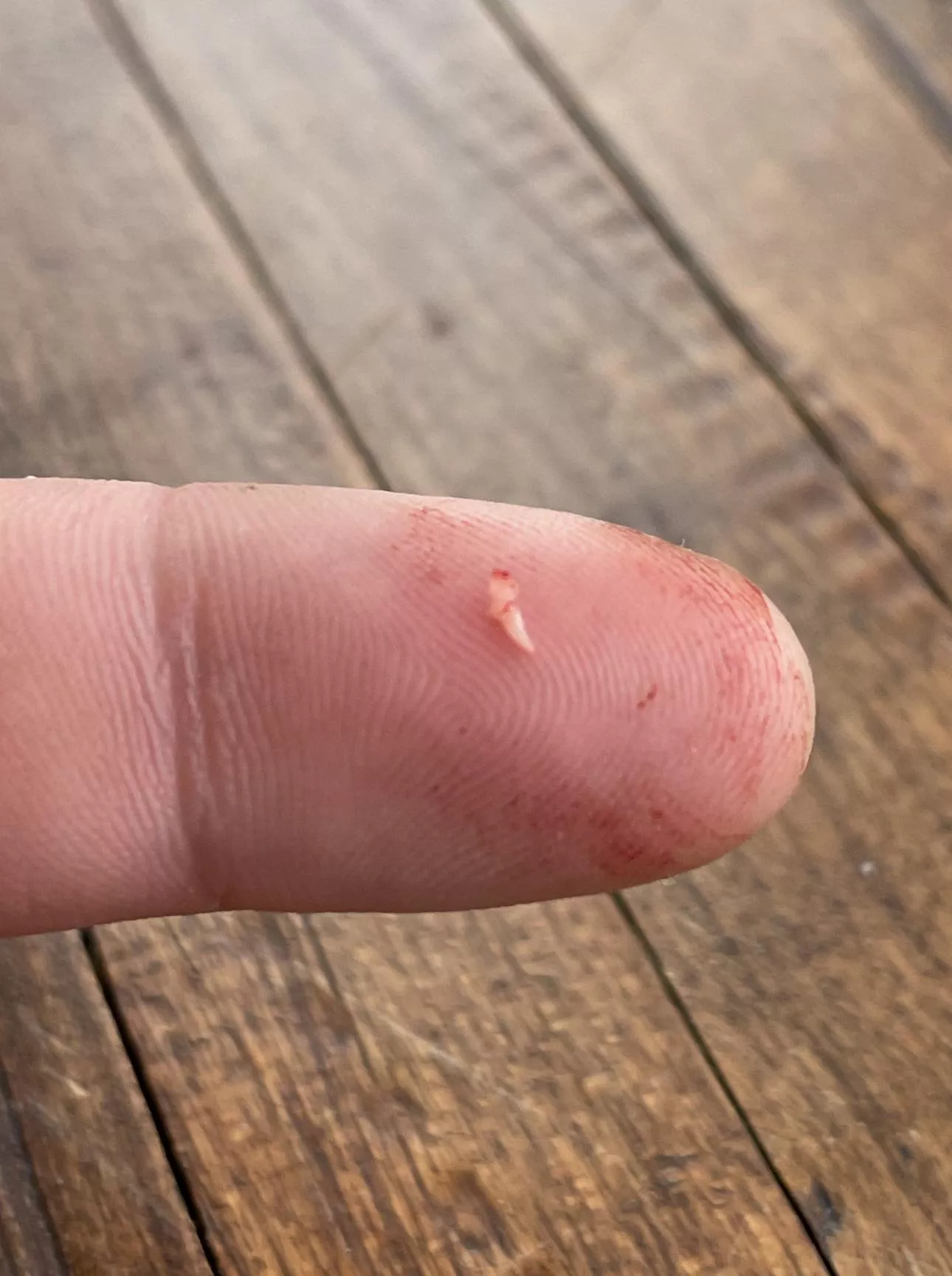 Angry Painful Butt Cheek Cyst posted by DopeZulla3000