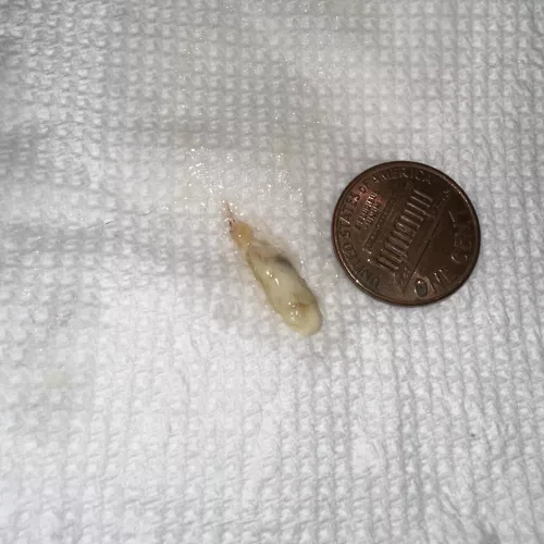 Mucus plug from a painfully blocked tear duct. Popped out into my nose following saline irrigation of the tear duct by my ophthalmologist. by 700x25C