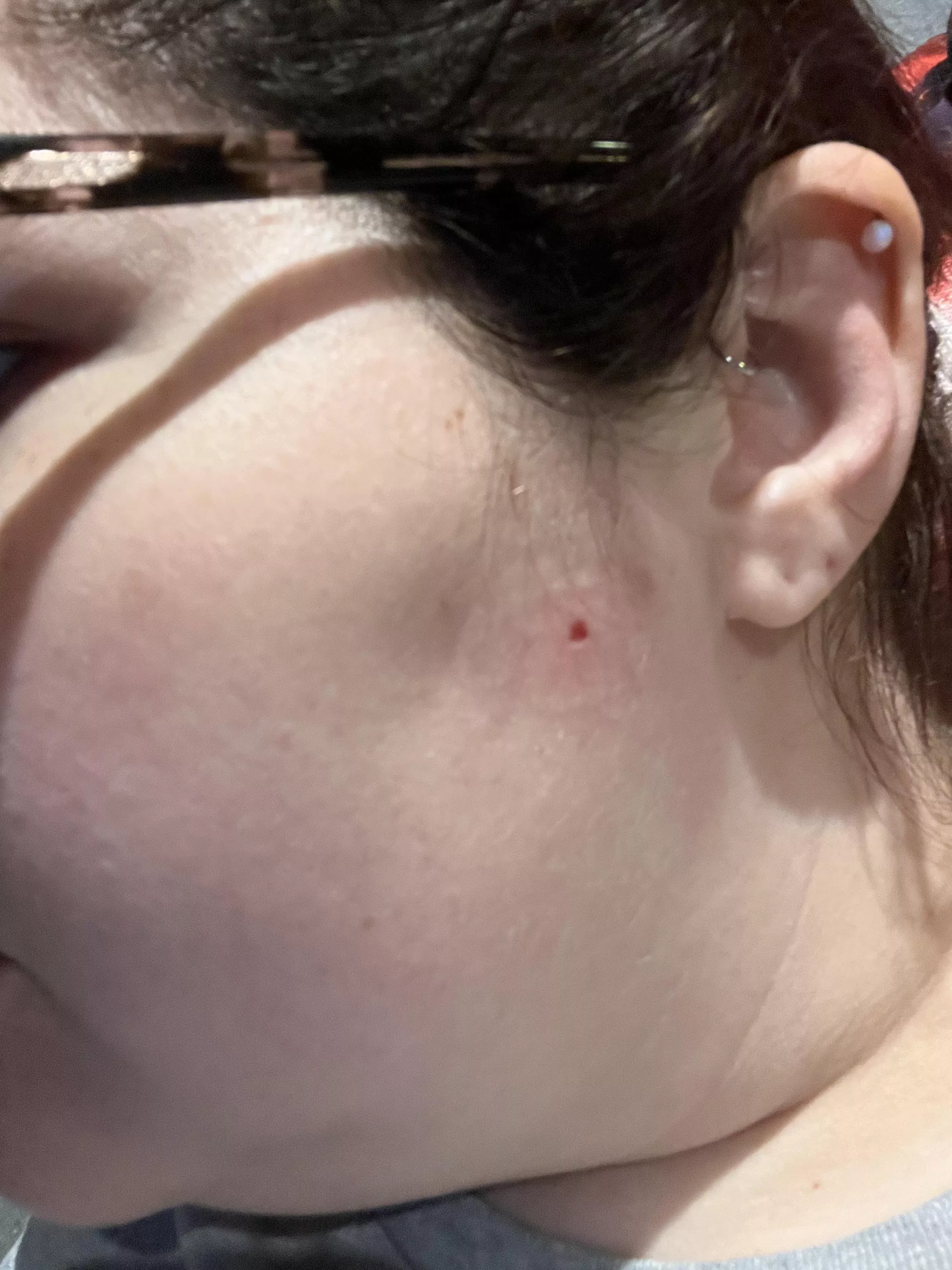 Had an irregular shaped mole shaved off my face today. It’s very red around it because I’m allergic to adhesive. Doctor sent it for biopsy and said they’ll call in the next few days. Fingers crossed it’s benign🤞🏻 posted by KaylaRocksss