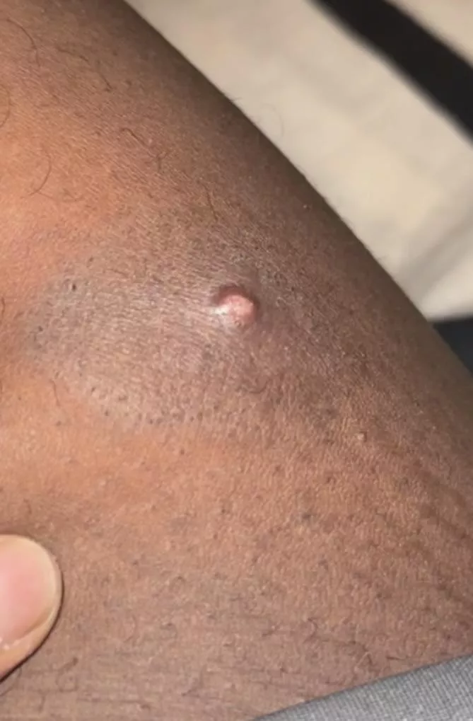 What is this under my thigh, Cyst or Pimple? posted by Low_Client_2942