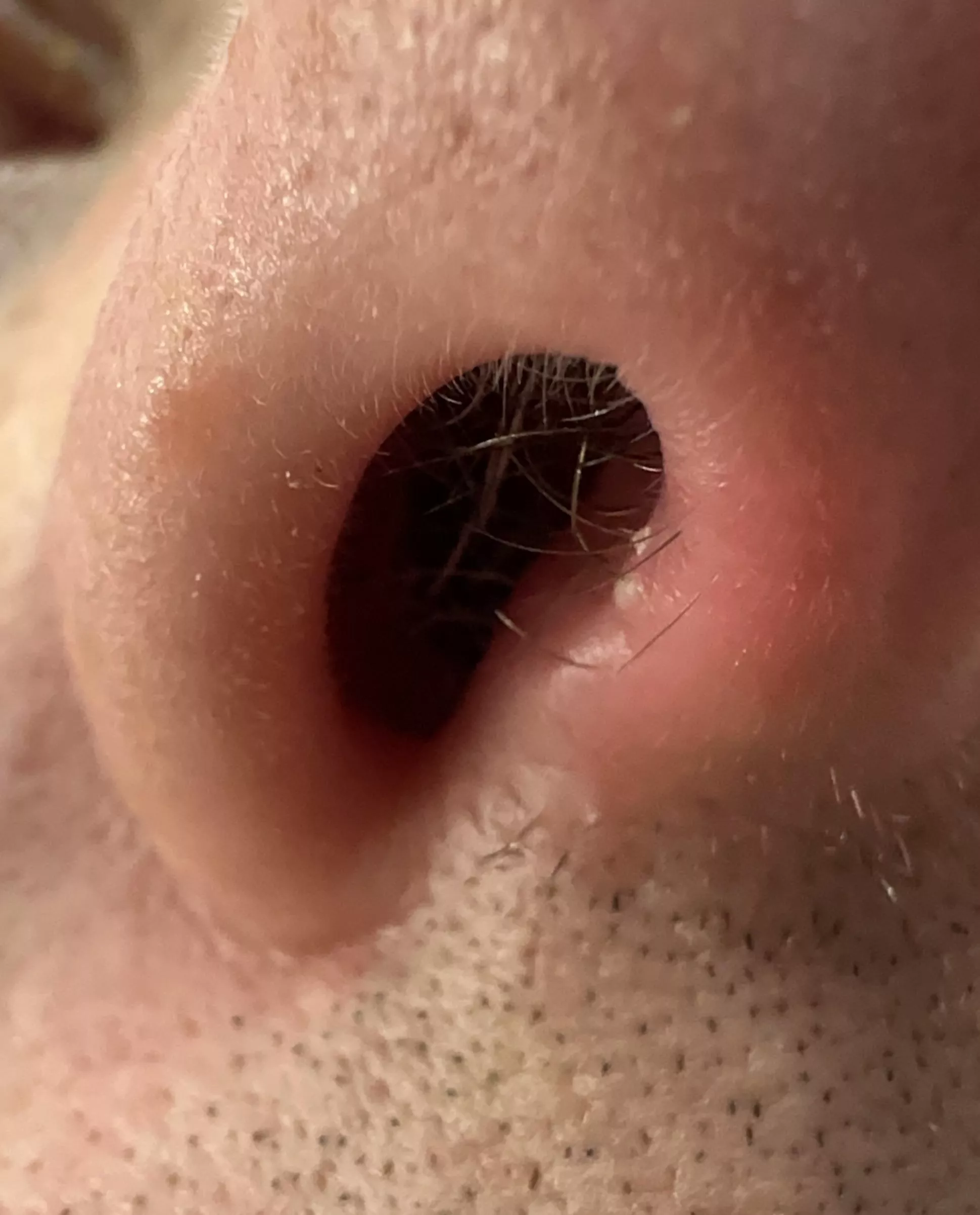 So little, yet powerfully painful and sneeze triggering when popped! posted by radiogeekau