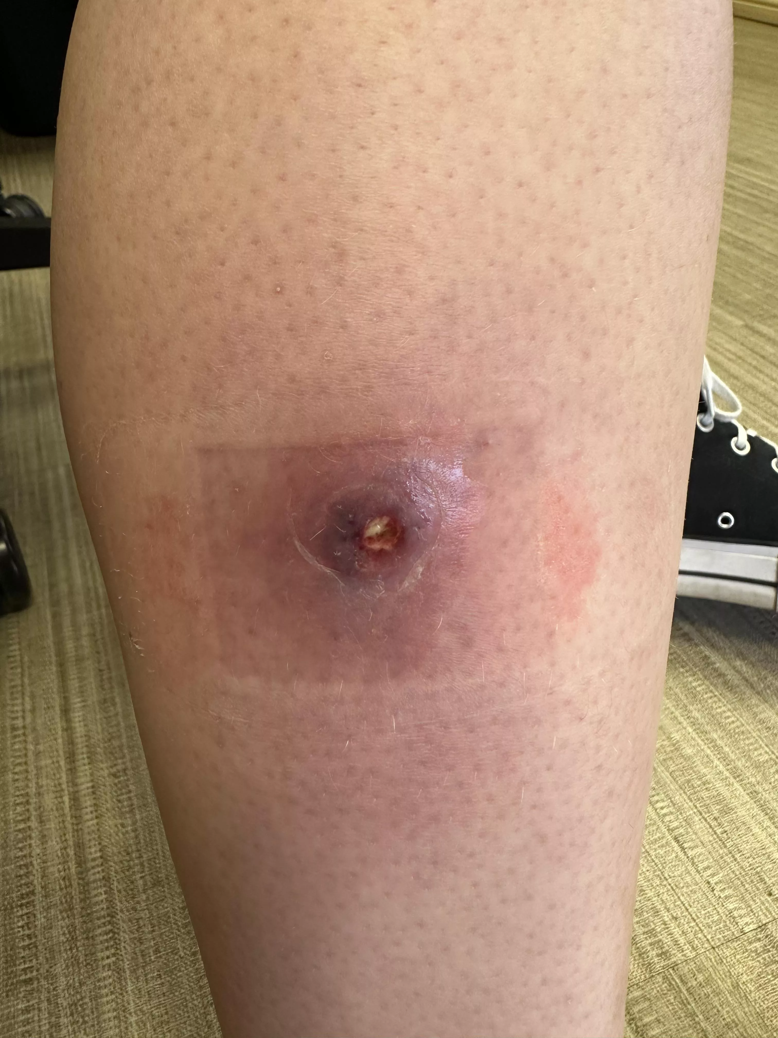 Cellulitis girl update! posted by krisc2619