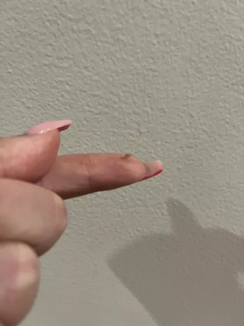 Finally got this sucker out of my scalp  by nicksbrunchattiffany