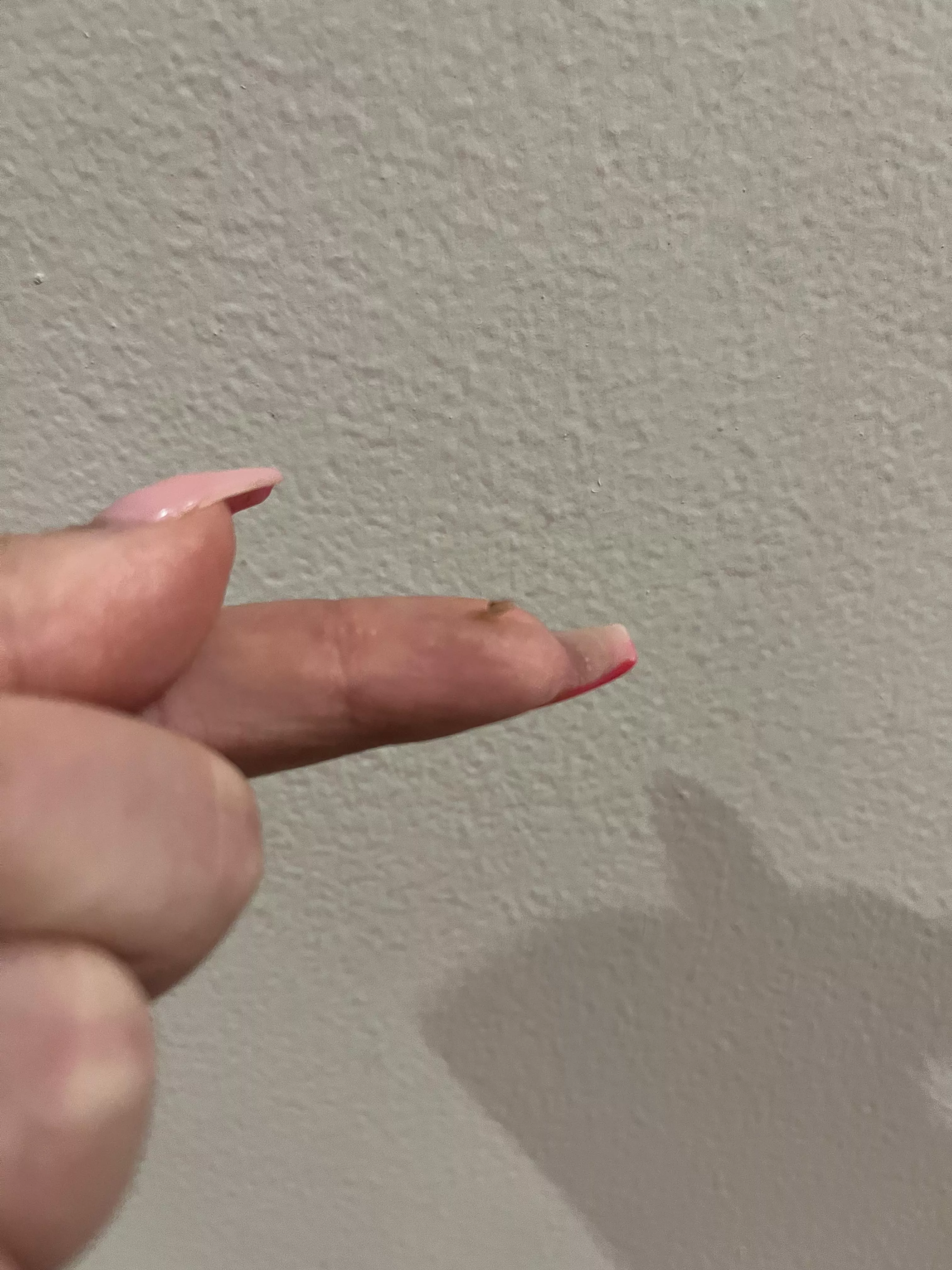 Finally got this sucker out of my scalp  posted by nicksbrunchattiffany