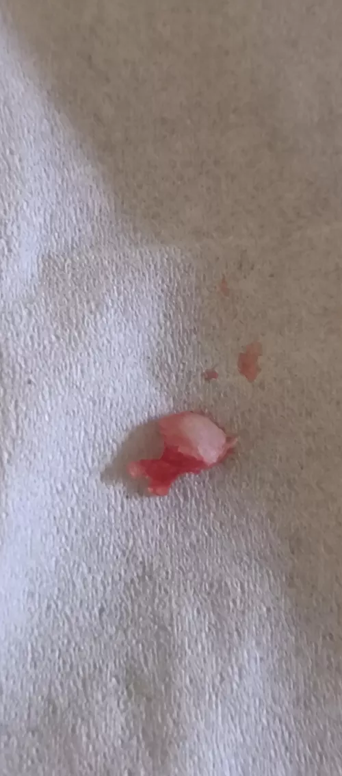 Shard of bone came out my gum by PrimaryEgg493