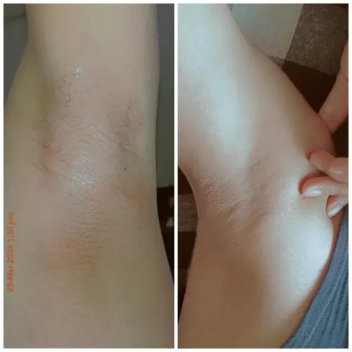 A glimpse of my boyfriends pits immediately after i waxed and an hour after i waxed his armpits by DivyaShouldSleepNow