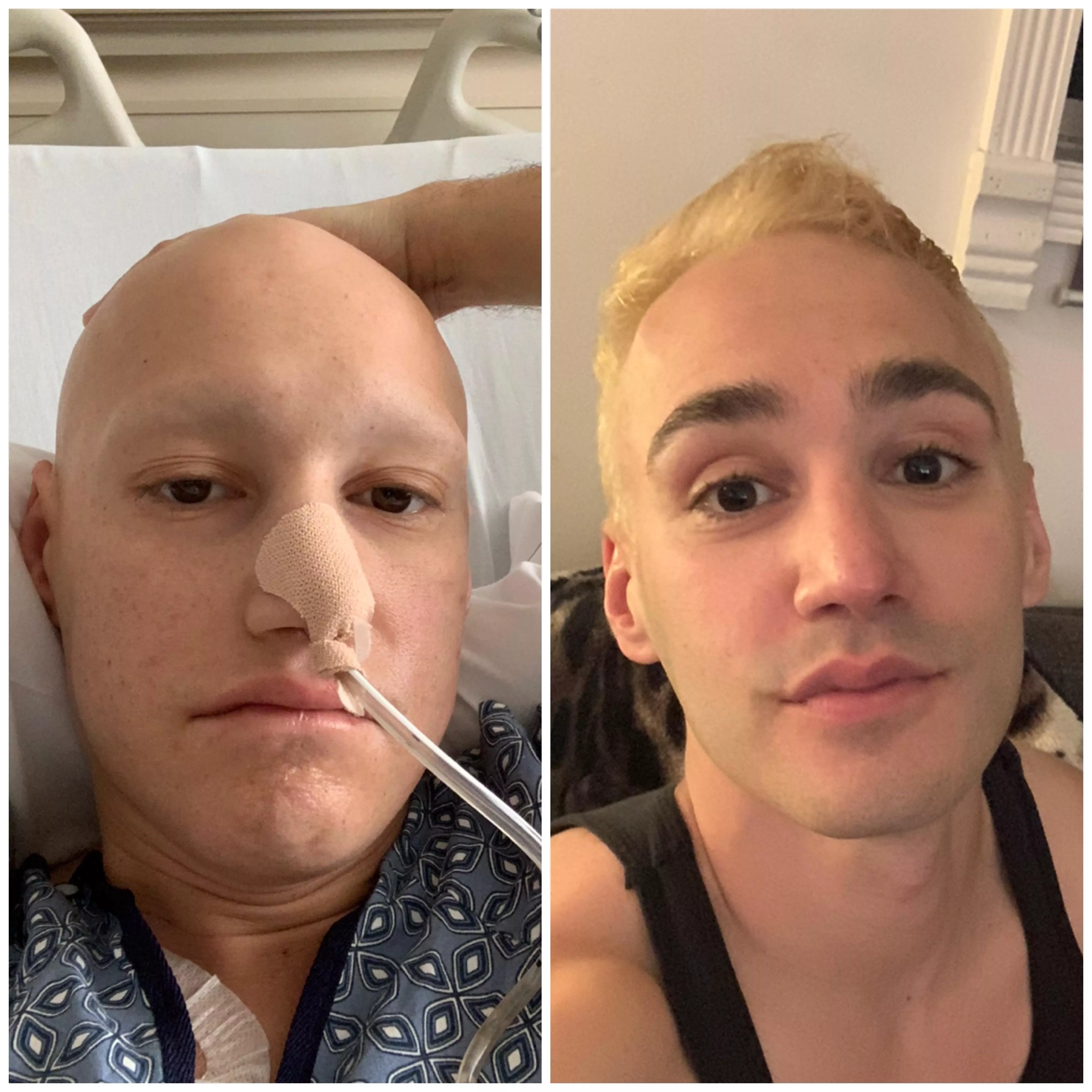 A year after my last chemo and I can finally say Im back to my old self (well...with a blonde upgrade ) #cancersurvivor posted by nickenpomach
