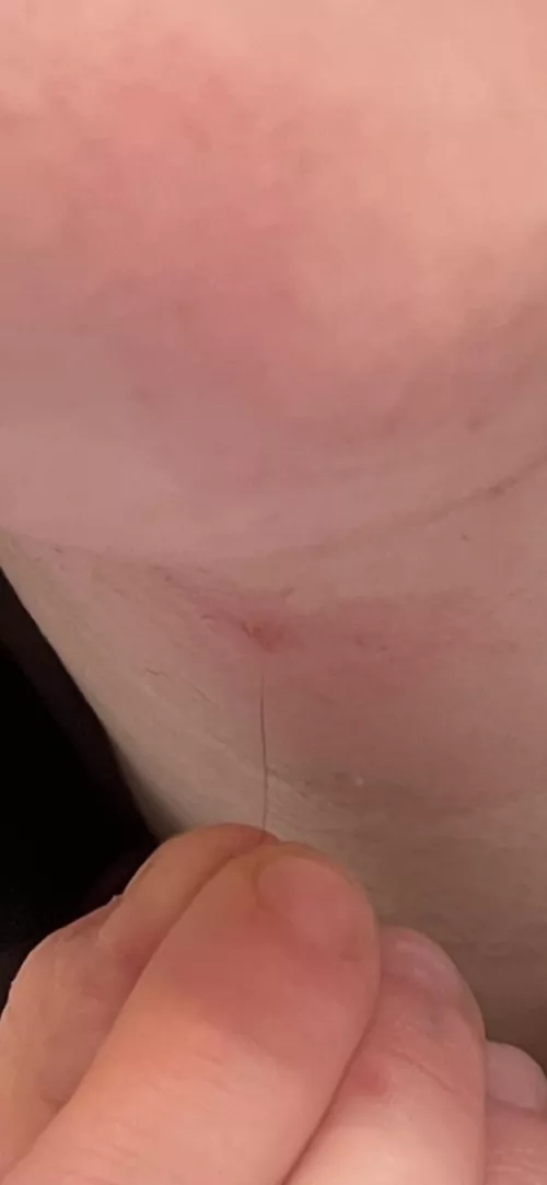 Finally got this ingrown hair out that’s been hiding for a year by pearlegs