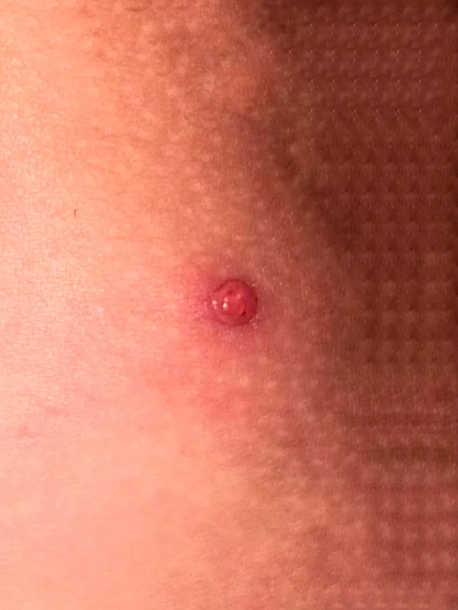 Pimple or boil on my thigh/butt posted by Bulky_Guarantee_4499