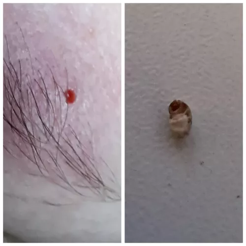 Eyebrow pore of Winer by Lonely-Grape1279