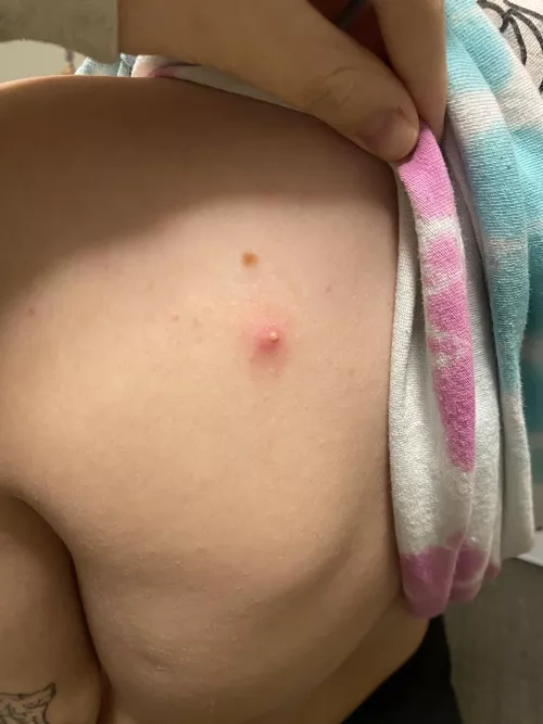 wanted to share my back pimple by Prestigious-Goose-30