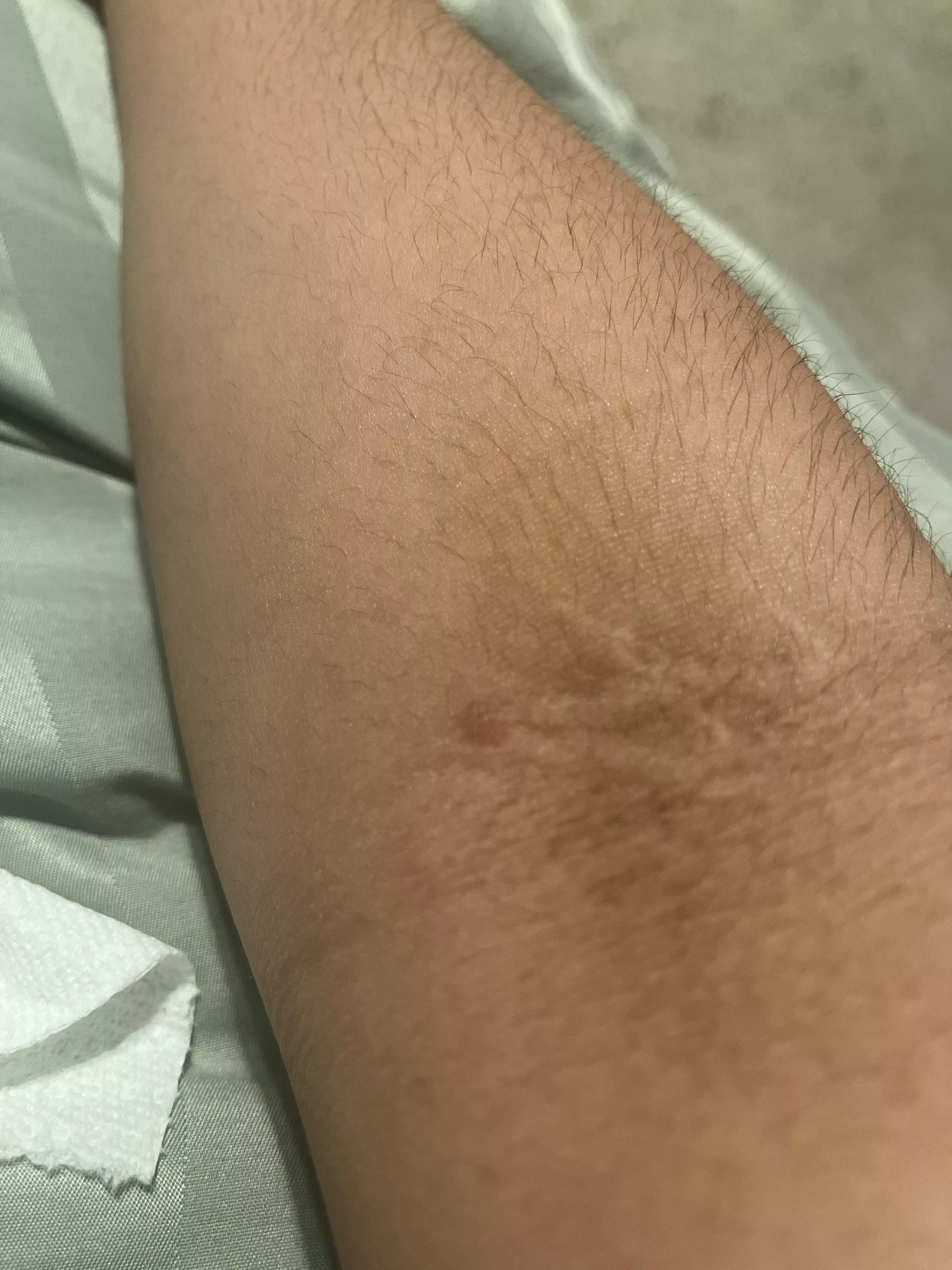 what is this weird bump on my arm. posted by rmjoeyfly