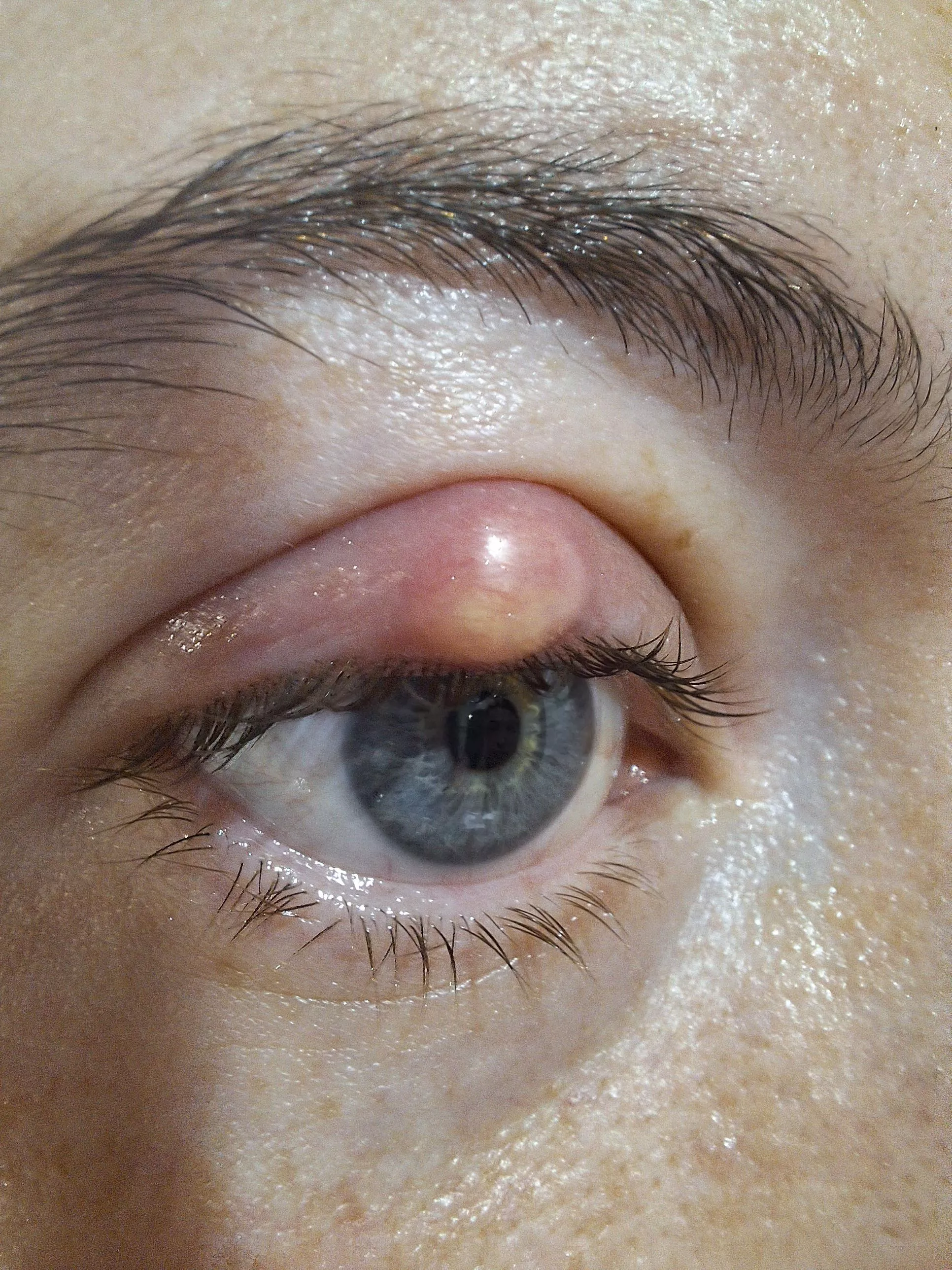 Chalazion/stye going to pop? posted by Sensitive_Piano5370