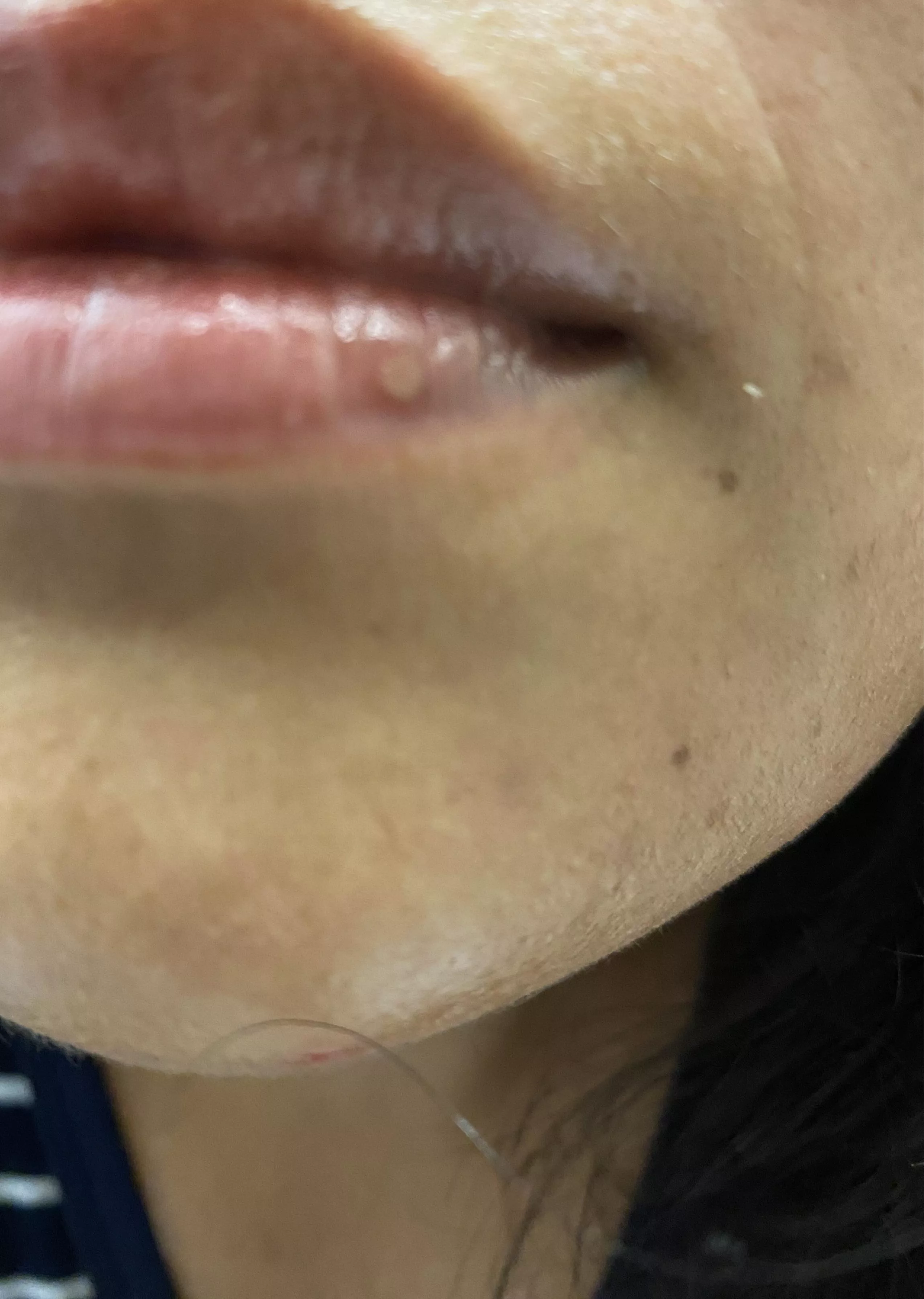 Is this a cold sore never had one posted by Ilovetortillasyum