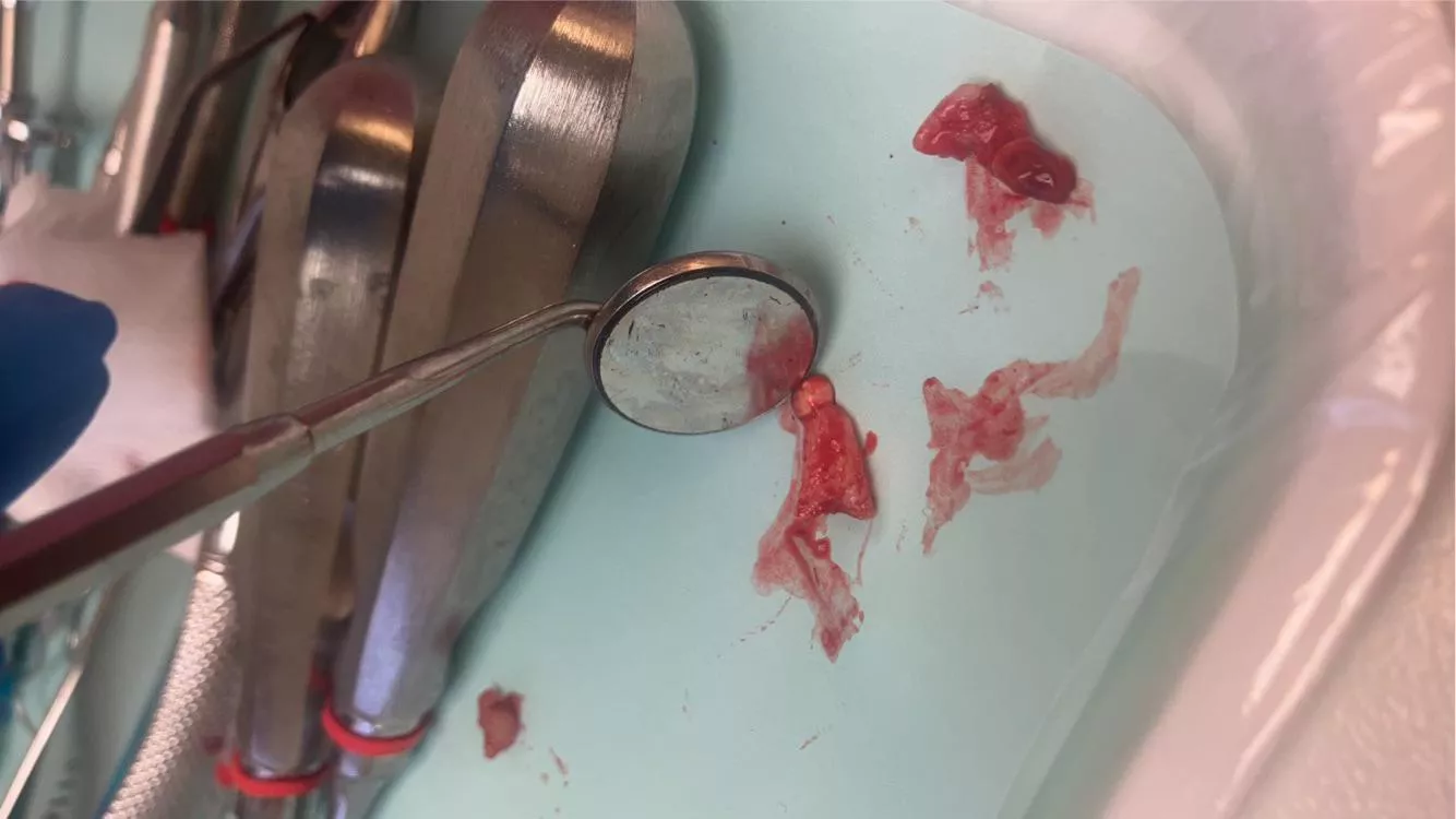 Had emergency oral surgery to remove an infection from an old root canal… posted by meme_abstinent